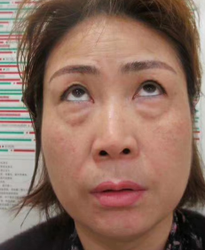 去眼袋手术