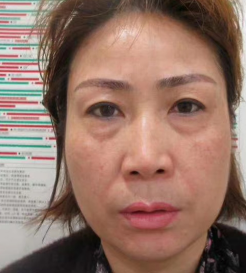 去眼袋手术