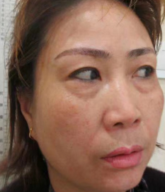 去眼袋手术
