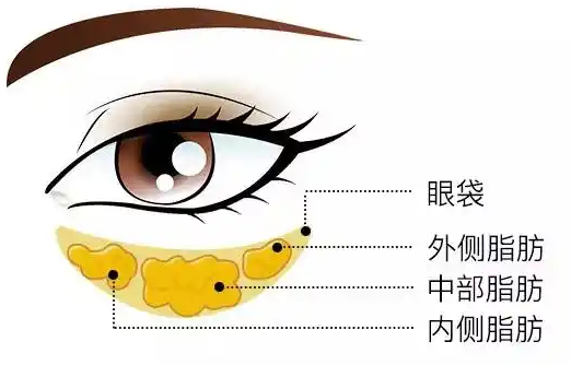 去眼袋手术