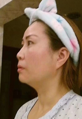 去眼袋手术