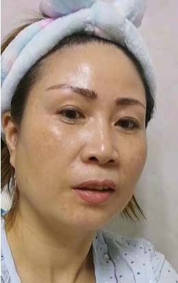 去眼袋手术