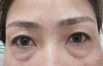 去眼袋手术
