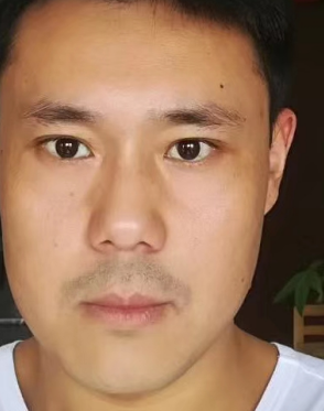 去眼袋手术