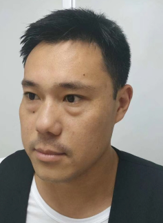 去眼袋手术