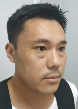去眼袋手术