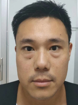 去眼袋手术