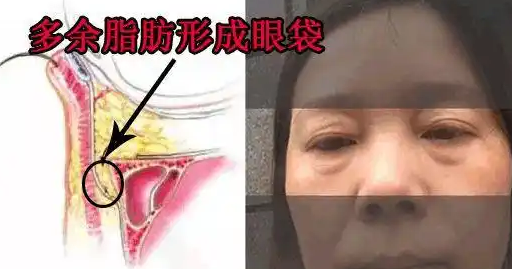去眼袋手术