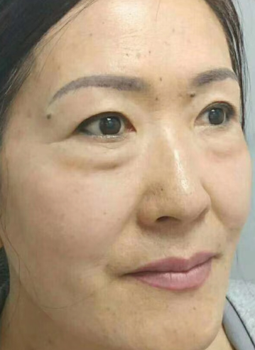 去眼袋手术