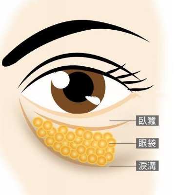 去眼袋手术