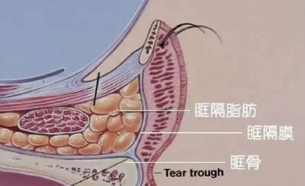 去眼袋手术