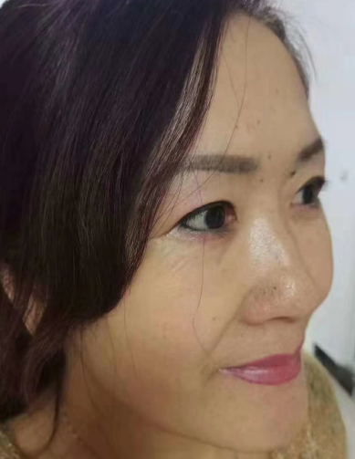 去眼袋手术