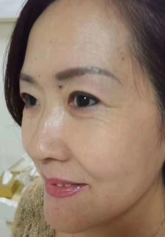 去眼袋手术