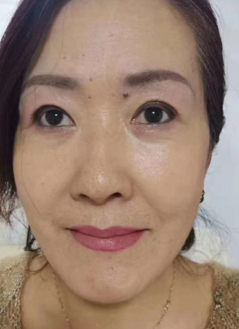 去眼袋手术