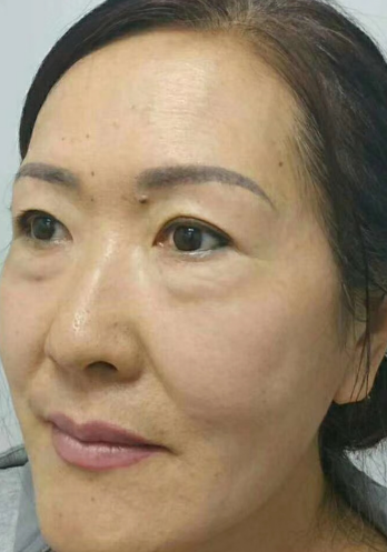 去眼袋手术