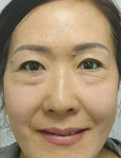 去眼袋手术