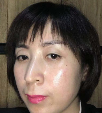 去眼袋手术