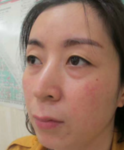 去眼袋手术