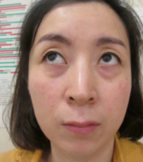 去眼袋手术
