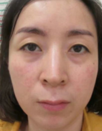 去眼袋手术