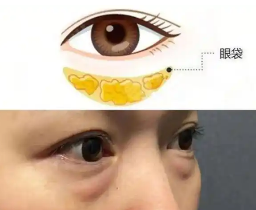 去眼袋手术