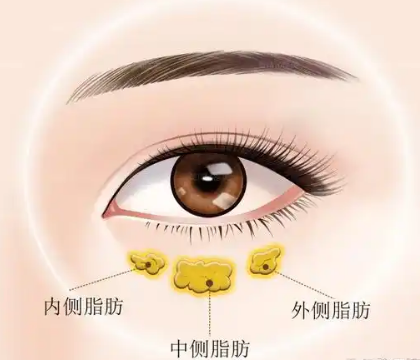 去眼袋手术