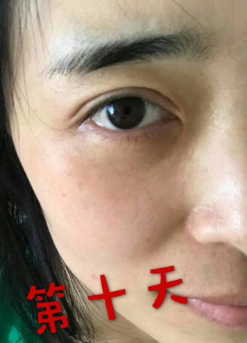 去眼袋手术