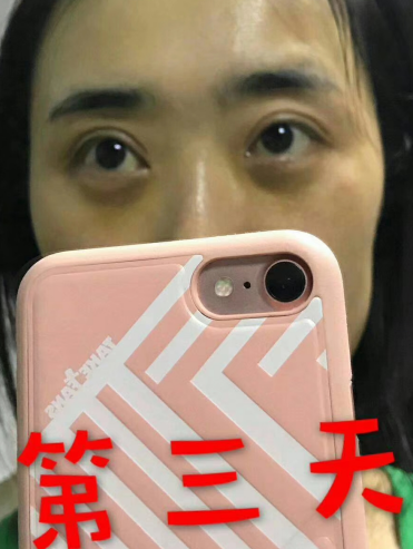 去眼袋手术