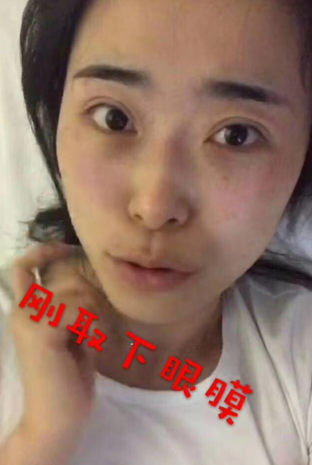 去眼袋手术
