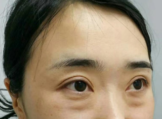 去眼袋手术