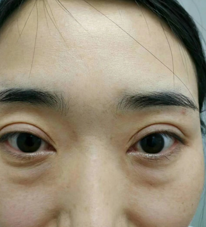 去眼袋手术