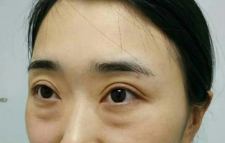 去眼袋手术