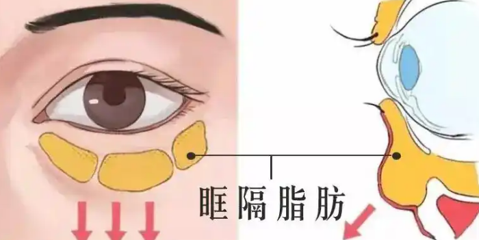 去眼袋手术