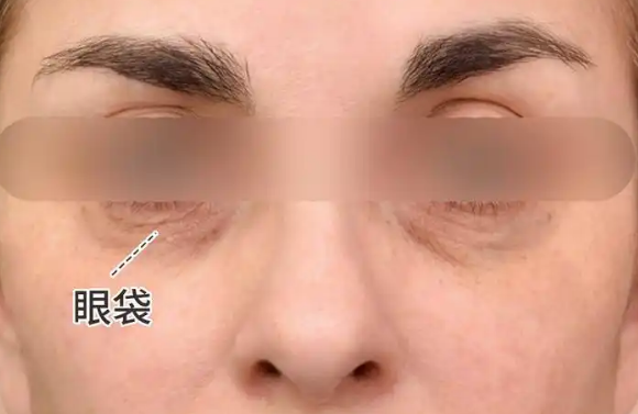 去眼袋手术