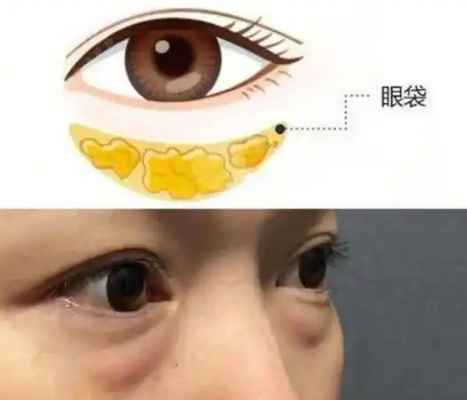 去眼袋手术