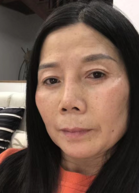 去眼袋手术
