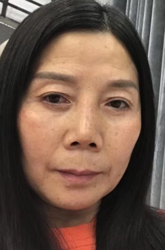 去眼袋手术