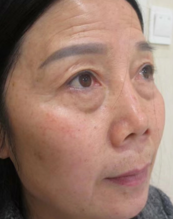 去眼袋手术