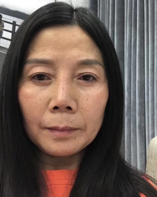 去眼袋手术