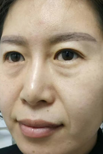去眼袋手术