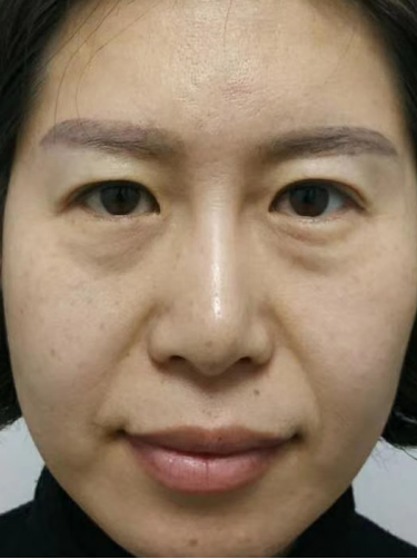 去眼袋手术