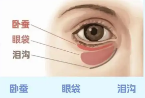 去眼袋手术
