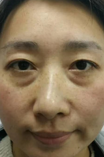 去眼袋手术