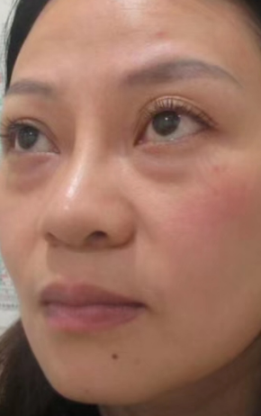 去眼袋手术