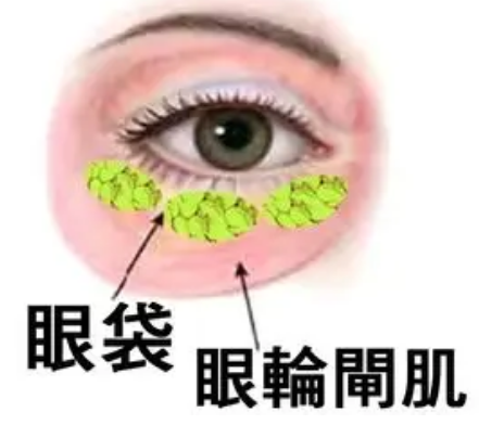 去眼袋手术