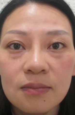 去眼袋手术