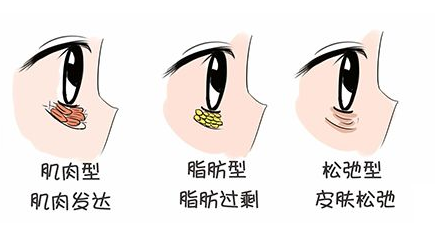 去眼袋手术