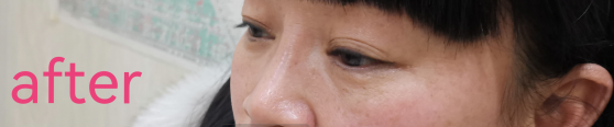 去眼袋手术