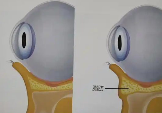 去眼袋手术