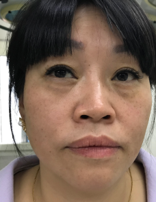去眼袋手术
